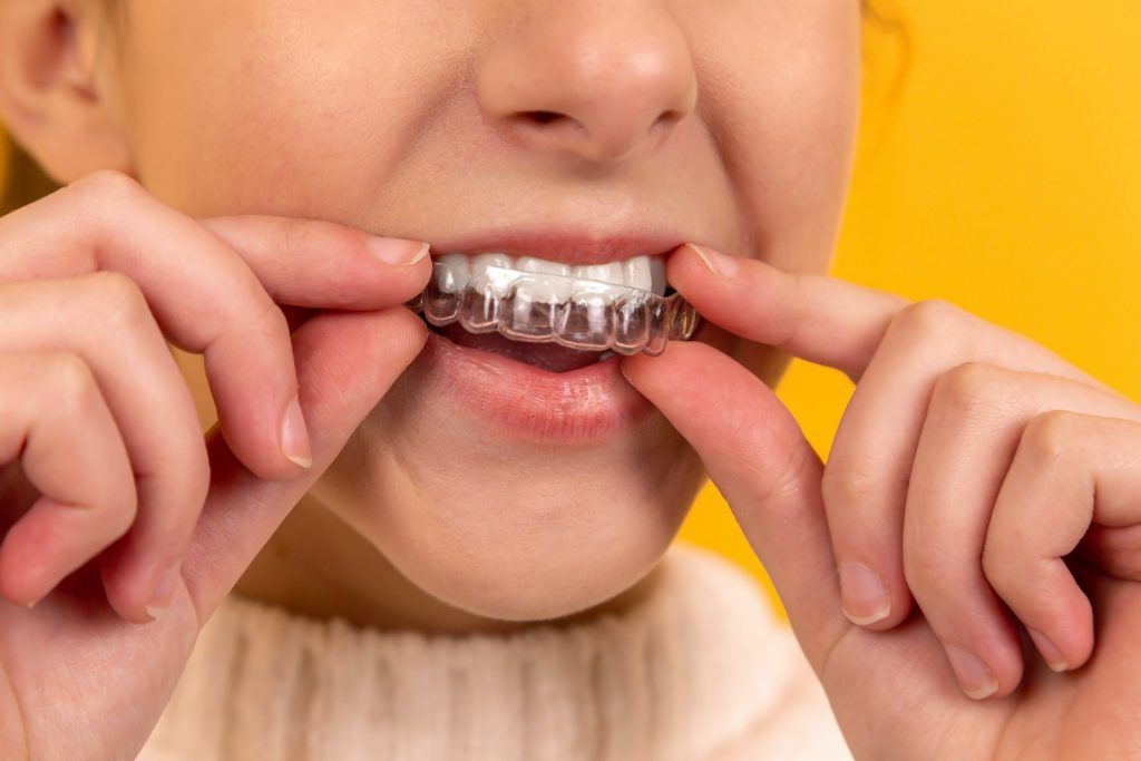 chica con ortodoncia invisalign