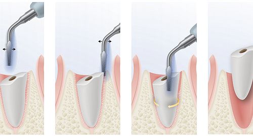 extracción atraumática dental