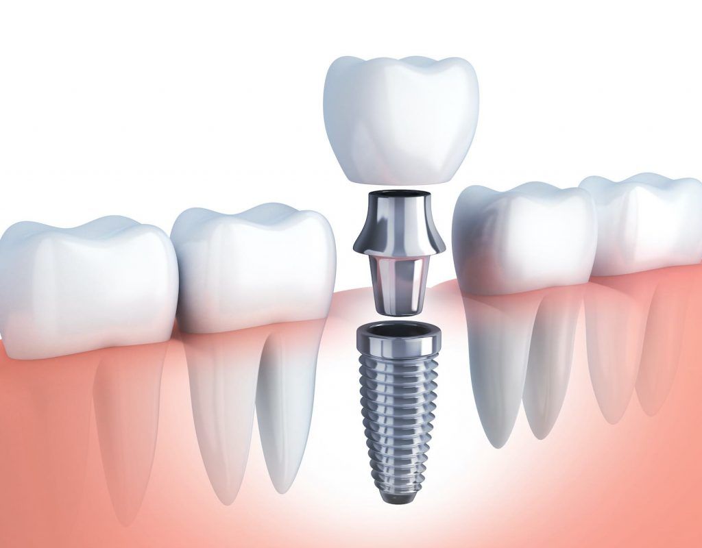 implantes dentales 3d