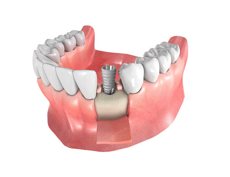 implantes expansión ósea