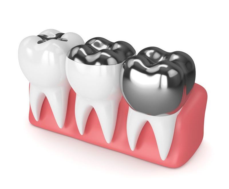 maqueta de una incrustación dental