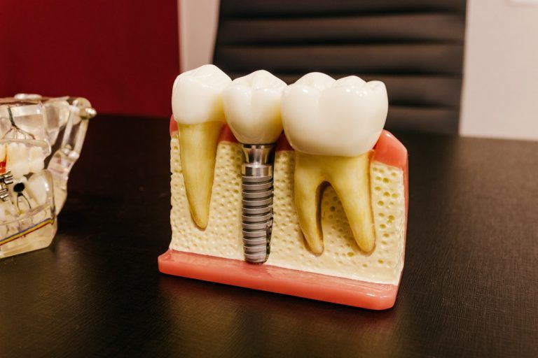 muestra de un implante dental