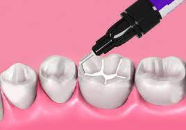 sellante dental