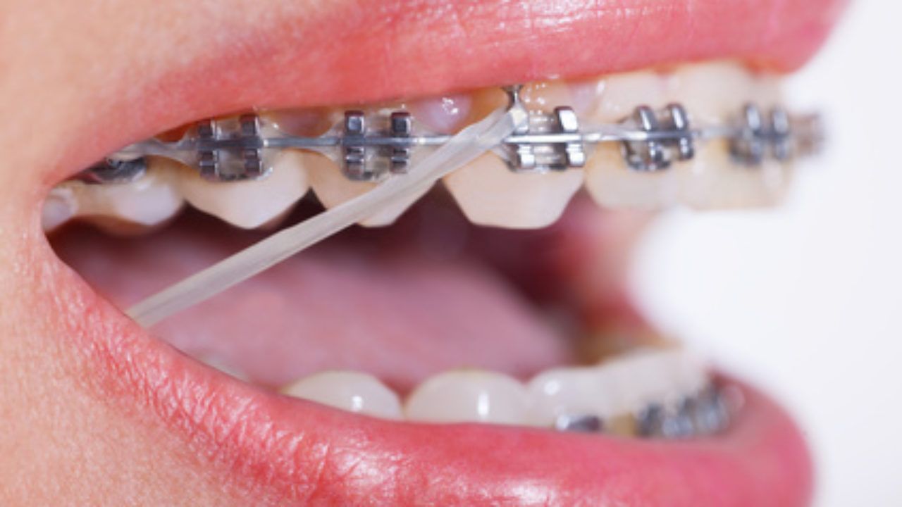 ¿Para qué sirven las gomas de los brackets?